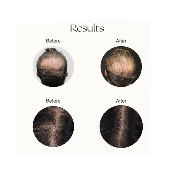 Nourish Mantra Advanced Hair Growth Serum For All Hair Thinning 1.69 fl oz - Picture 2 of 8